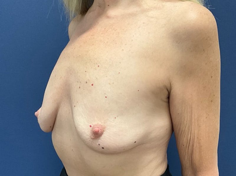  Breast Lift with Augmentation Dr. Booth Before & After Gallery - Patient 371675 - Image 3