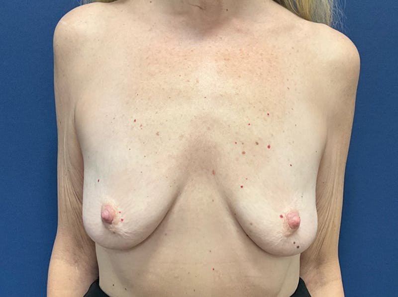  Breast Lift with Augmentation Dr. Booth Before & After Gallery - Patient 371675 - Image 1