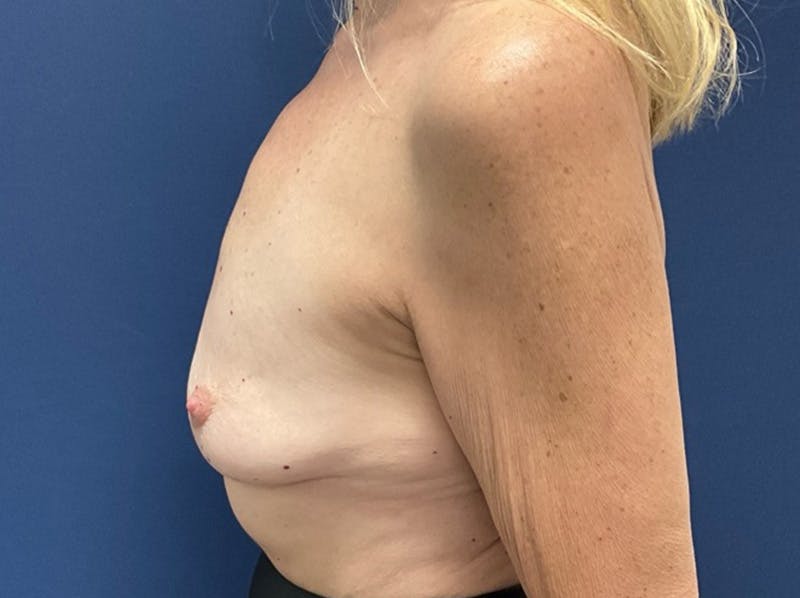  Breast Lift with Augmentation Dr. Booth Before & After Gallery - Patient 371675 - Image 5