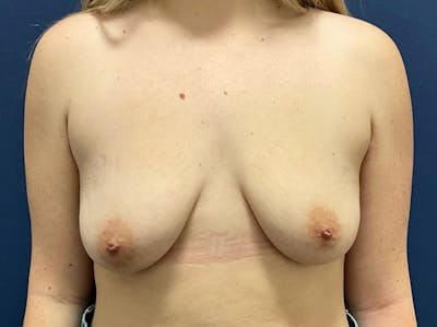 Breast Lift with Augmentation Dr. Booth Before & After Gallery - Patient 302768 - Image 1