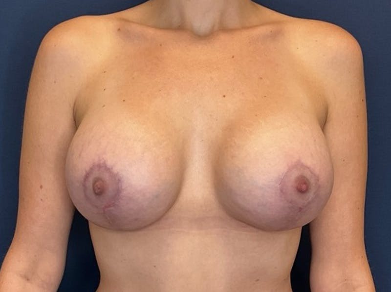  Breast Lift with Augmentation Dr. Booth Before & After Gallery - Patient 241430 - Image 2