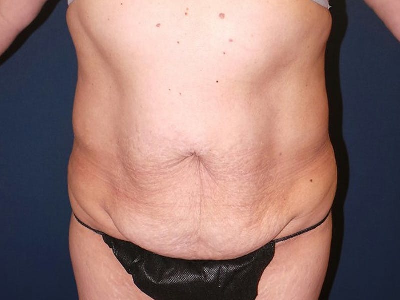 Tummy Tuck by Dr. Booth Before & After Gallery - Patient 140747 - Image 1