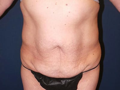 Tummy Tuck by Dr. Booth Before & After Gallery - Patient 140747 - Image 1