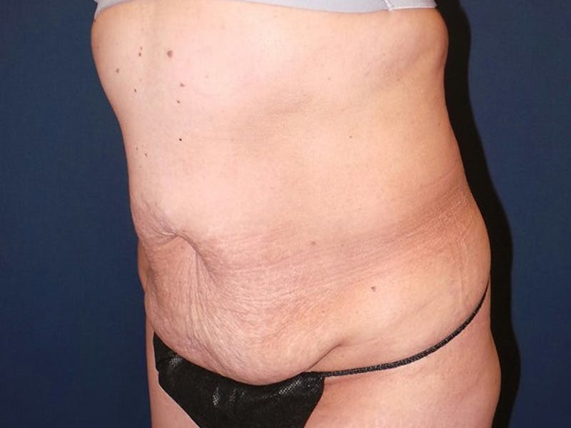 Tummy Tuck by Dr. Booth Before & After Gallery - Patient 140747 - Image 3