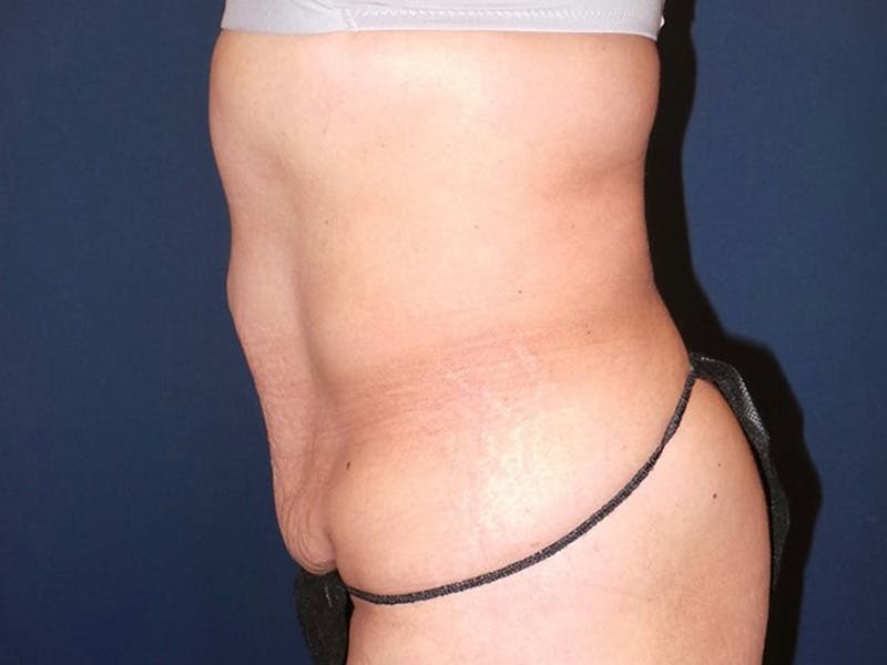 Tummy Tuck by Dr. Booth Before & After Gallery - Patient 140747 - Image 5