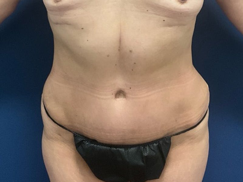 Tummy Tuck by Dr. Booth Before & After Gallery - Patient 140747 - Image 2