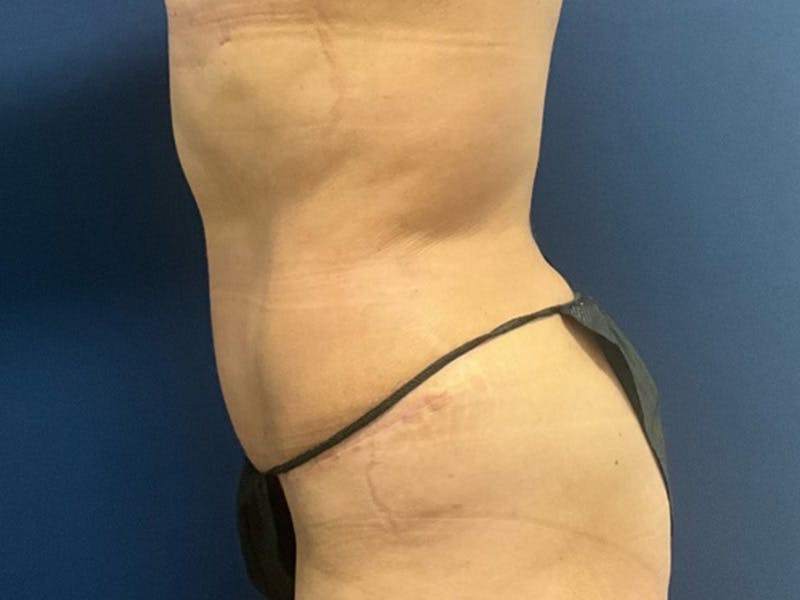 Tummy Tuck by Dr. Booth Before & After Gallery - Patient 140747 - Image 6