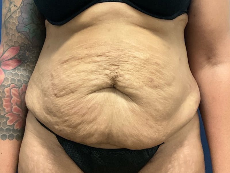 Tummy Tuck by Dr. Booth Before & After Gallery - Patient 427779 - Image 1