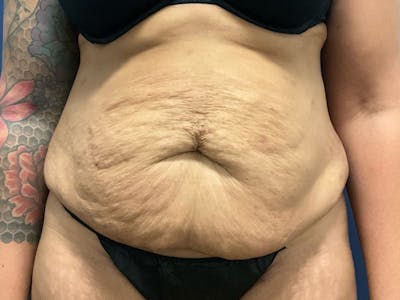 Tummy Tuck by Dr. Booth Before & After Gallery - Patient 427779 - Image 1