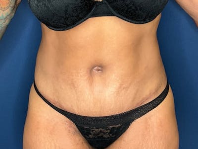 Tummy Tuck by Dr. Booth Before & After Gallery - Patient 427779 - Image 2