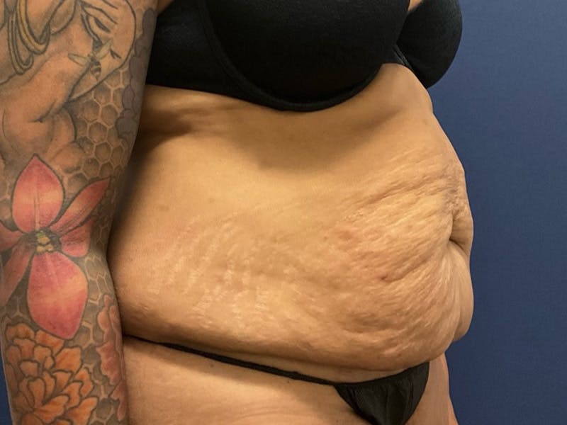 Tummy Tuck by Dr. Booth Before & After Gallery - Patient 427779 - Image 3