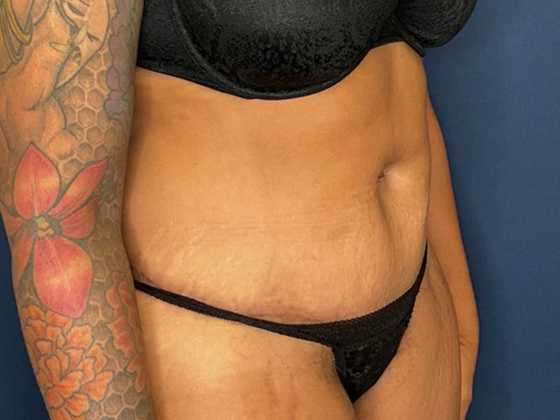 Tummy Tuck by Dr. Booth Before & After Gallery - Patient 427779 - Image 4