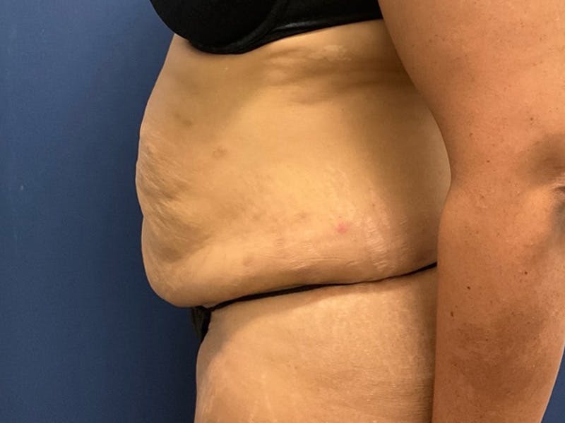 Tummy Tuck by Dr. Booth Before & After Gallery - Patient 427779 - Image 5
