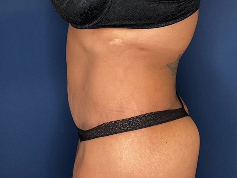 Tummy Tuck by Dr. Booth Before & After Gallery - Patient 427779 - Image 6