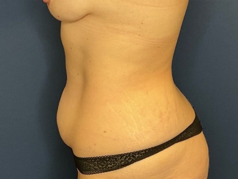 Tummy Tuck by Dr. Booth Before & After Gallery - Patient 415856 - Image 5