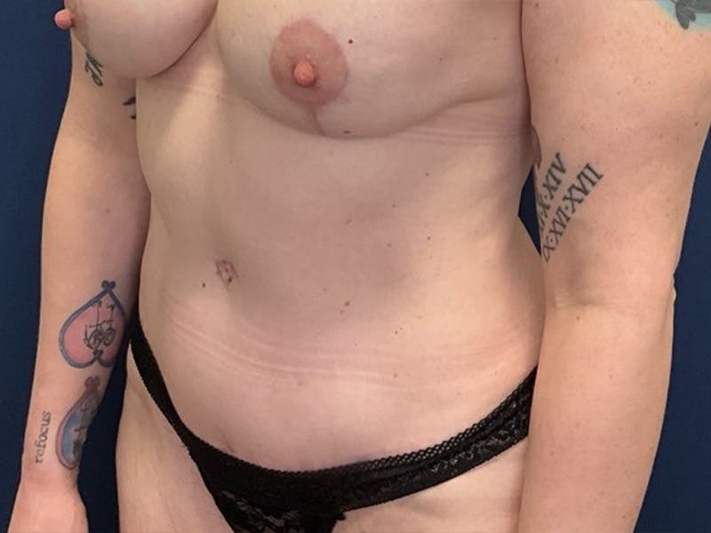 Tummy Tuck by Dr. Booth Before & After Gallery - Patient 415856 - Image 4