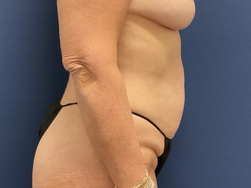 Tummy Tuck by Dr. Booth Before & After Gallery - Patient 550456 - Image 5