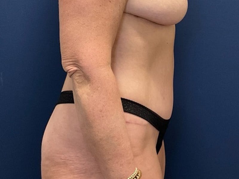 Tummy Tuck by Dr. Booth Before & After Gallery - Patient 550456 - Image 6