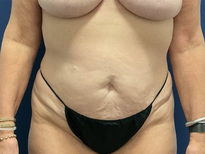 Tummy Tuck by Dr. Booth Before & After Gallery - Patient 550456 - Image 1
