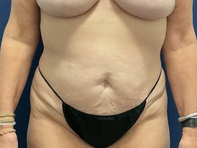 Tummy Tuck by Dr. Booth Before & After Gallery - Patient 550456 - Image 1