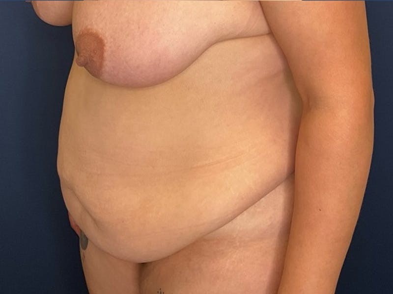 Tummy Tuck by Dr. Booth Before & After Gallery - Patient 170729 - Image 7