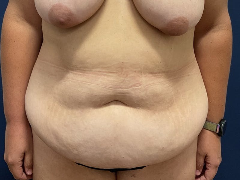 Tummy Tuck by Dr. Booth Before & After Gallery - Patient 195258 - Image 1