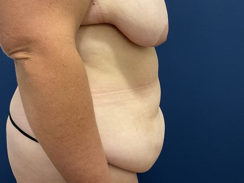 Tummy Tuck by Dr. Booth Before & After Gallery - Patient 195258 - Image 7