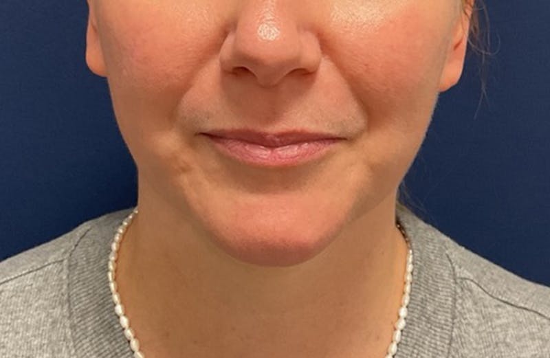MyEllevate by Dr. Booth Before & After Gallery - Patient 117235 - Image 5