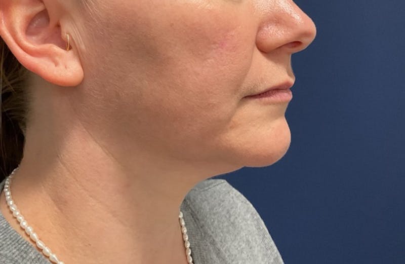 MyEllevate by Dr. Booth Before & After Gallery - Patient 117235 - Image 3
