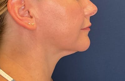 Submental Liposuction by Dr. Booth Before & After Gallery - Patient 210632 - Image 2