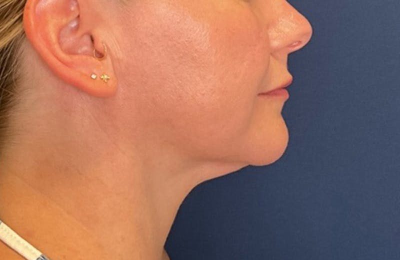 MyEllevate by Dr. Booth Before & After Gallery - Patient 117235 - Image 2