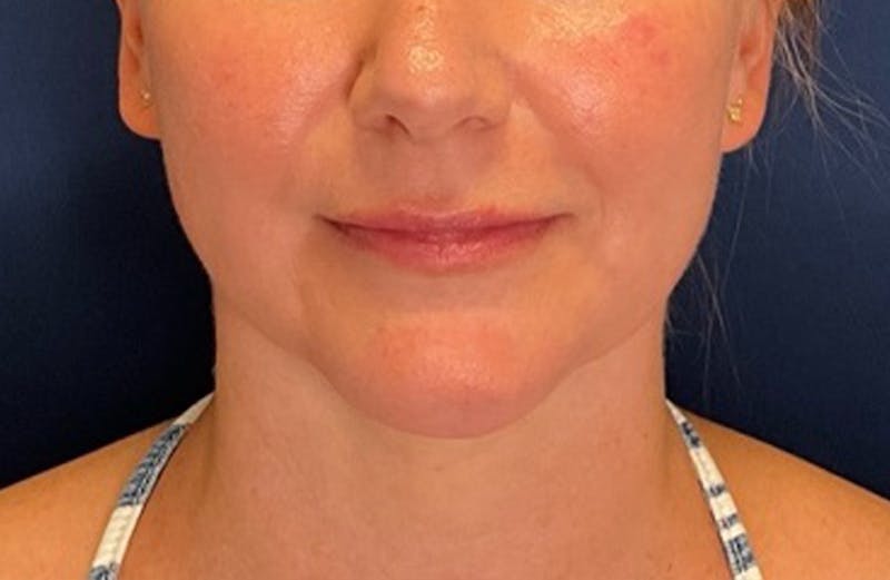 MyEllevate by Dr. Booth Before & After Gallery - Patient 117235 - Image 6