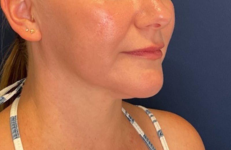 MyEllevate by Dr. Booth Before & After Gallery - Patient 117235 - Image 4