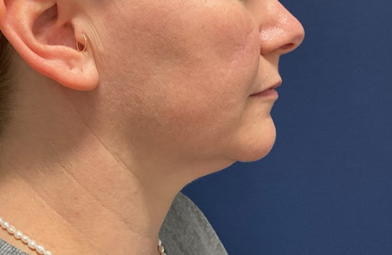 MyEllevate by Dr. Booth Before & After Gallery - Patient 117235 - Image 1