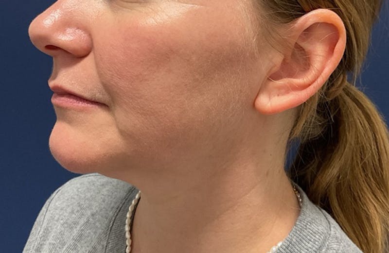 MyEllevate by Dr. Booth Before & After Gallery - Patient 117235 - Image 7