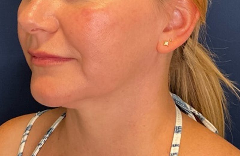 MyEllevate by Dr. Booth Before & After Gallery - Patient 117235 - Image 8