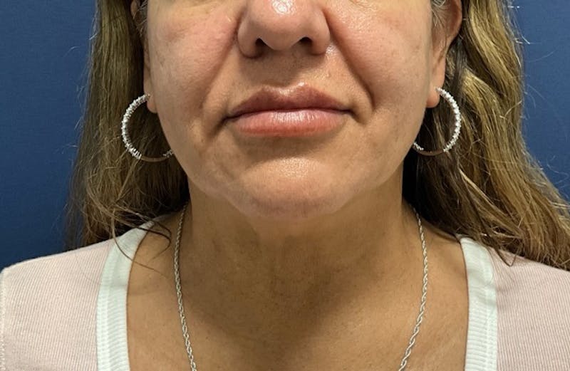 MyEllevate by Dr. Booth Before & After Gallery - Patient 188330 - Image 3