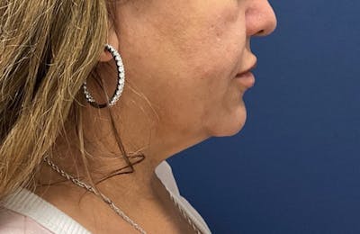 MyEllevate by Dr. Booth Before & After Gallery - Patient 188330 - Image 1