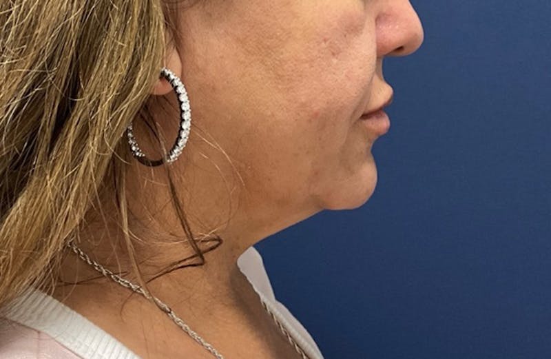 MyEllevate by Dr. Booth Before & After Gallery - Patient 188330 - Image 1