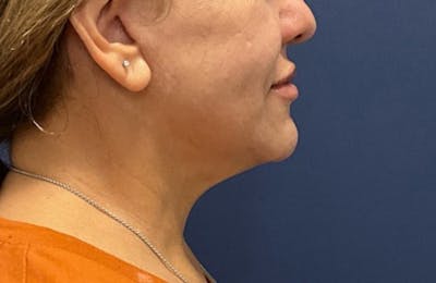 MyEllevate by Dr. Booth Before & After Gallery - Patient 188330 - Image 2