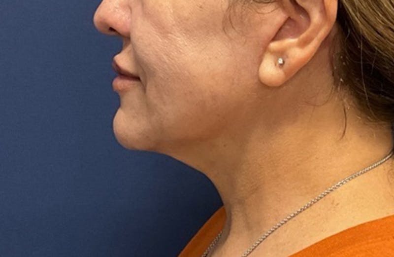 MyEllevate by Dr. Booth Before & After Gallery - Patient 188330 - Image 6