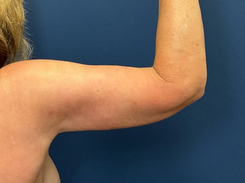 Brachioplasty by Dr. Booth Before & After Gallery - Patient 403892 - Image 4