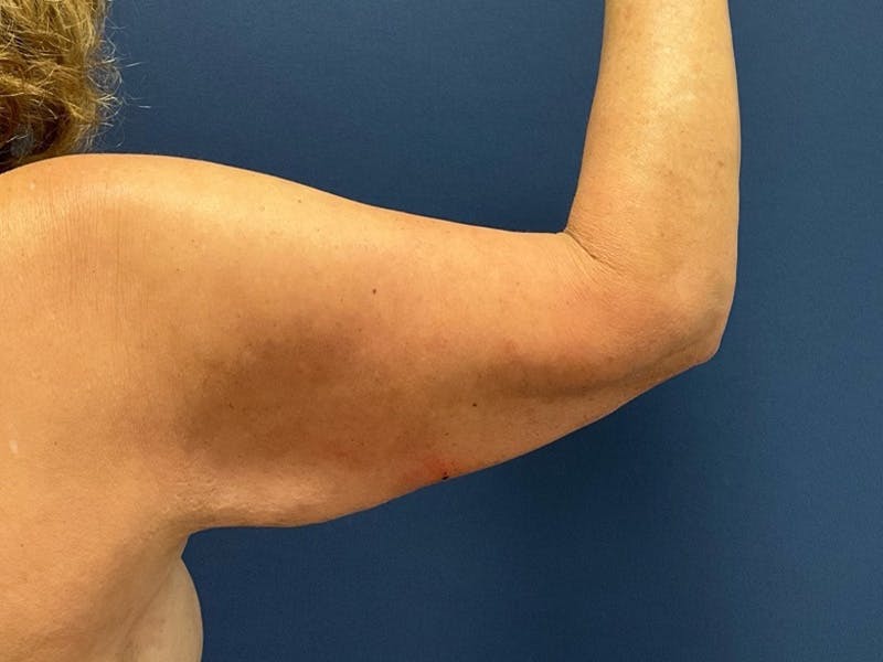 Brachioplasty by Dr. Booth Before & After Gallery - Patient 403892 - Image 3