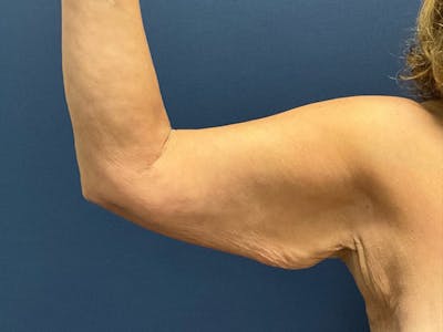 Brachioplasty by Dr. Booth Before & After Gallery - Patient 403892 - Image 1