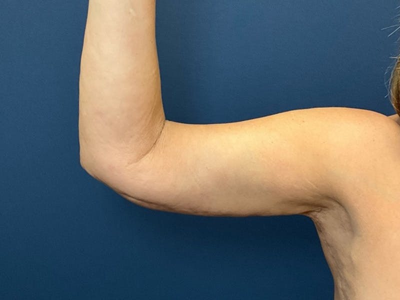 Brachioplasty by Dr. Booth Before & After Gallery - Patient 403892 - Image 2