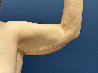 Brachioplasty by Dr. Booth Before & After Gallery - Patient 125200 - Image 1