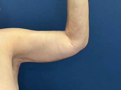 Brachioplasty by Dr. Booth Before & After Gallery - Patient 125200 - Image 2