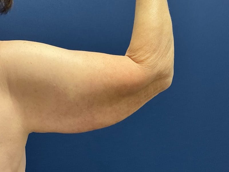 Brachioplasty by Dr. Booth Before & After Gallery - Patient 125200 - Image 3