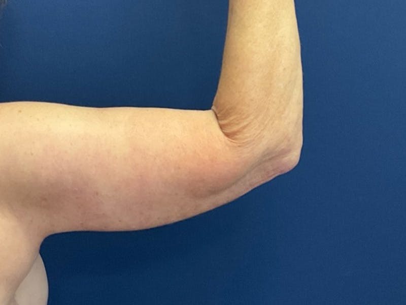 Brachioplasty by Dr. Booth Before & After Gallery - Patient 125200 - Image 4
