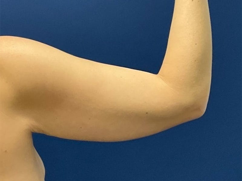 Brachioplasty by Dr. Booth Before & After Gallery - Patient 184931 - Image 1